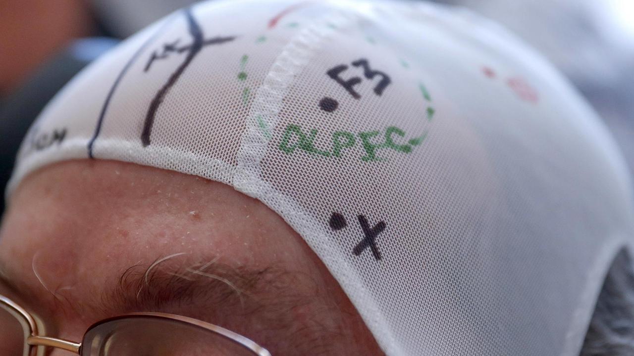 Nahaufnahe einer Kappe mit Markierungen auf dem Kopf eines Patienten. Nahaufnahe einer Kappe mit Markierungen auf dem Kopf eines Patienten.