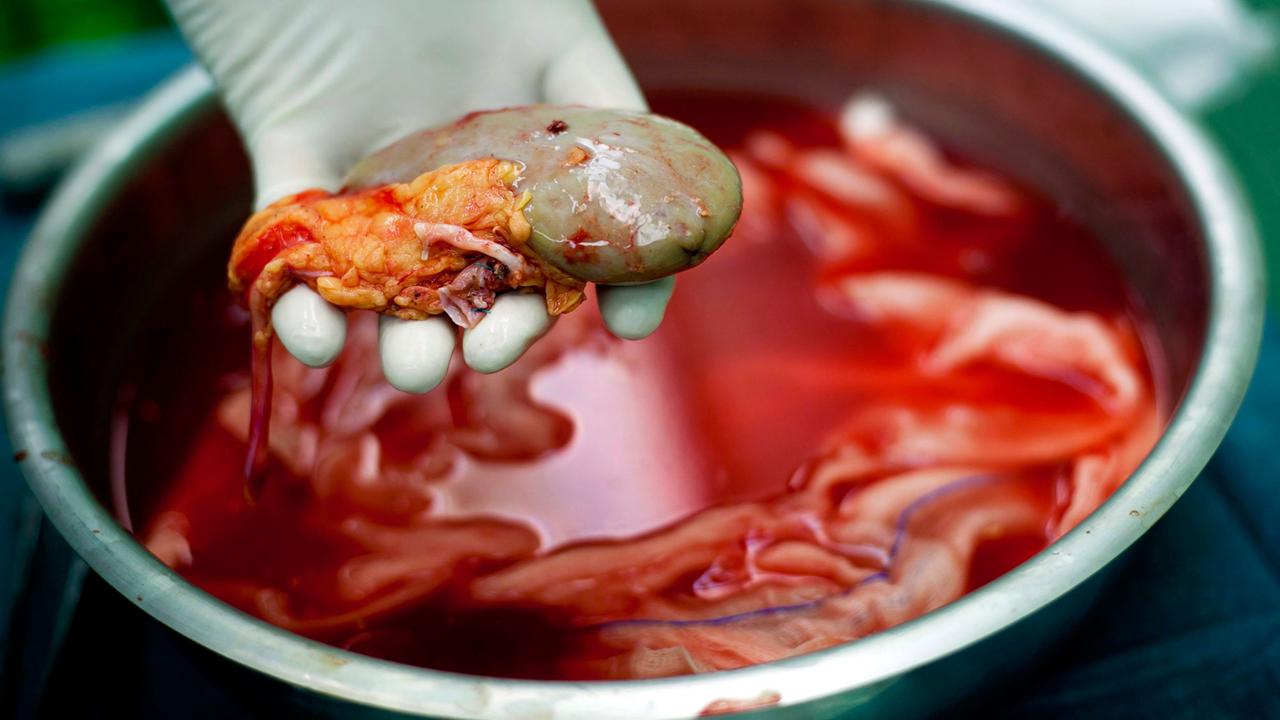 Eine zur Transplantation vorgesehene Niere wird von einer behandschuhten Hand aus einer Metallschüssel genommen.