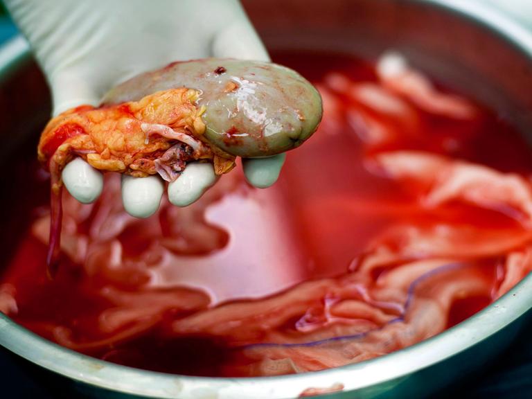 Eine zur Transplantation vorgesehene Niere wird von einer behandschuhten Hand aus einer Metallschüssel genommen.
