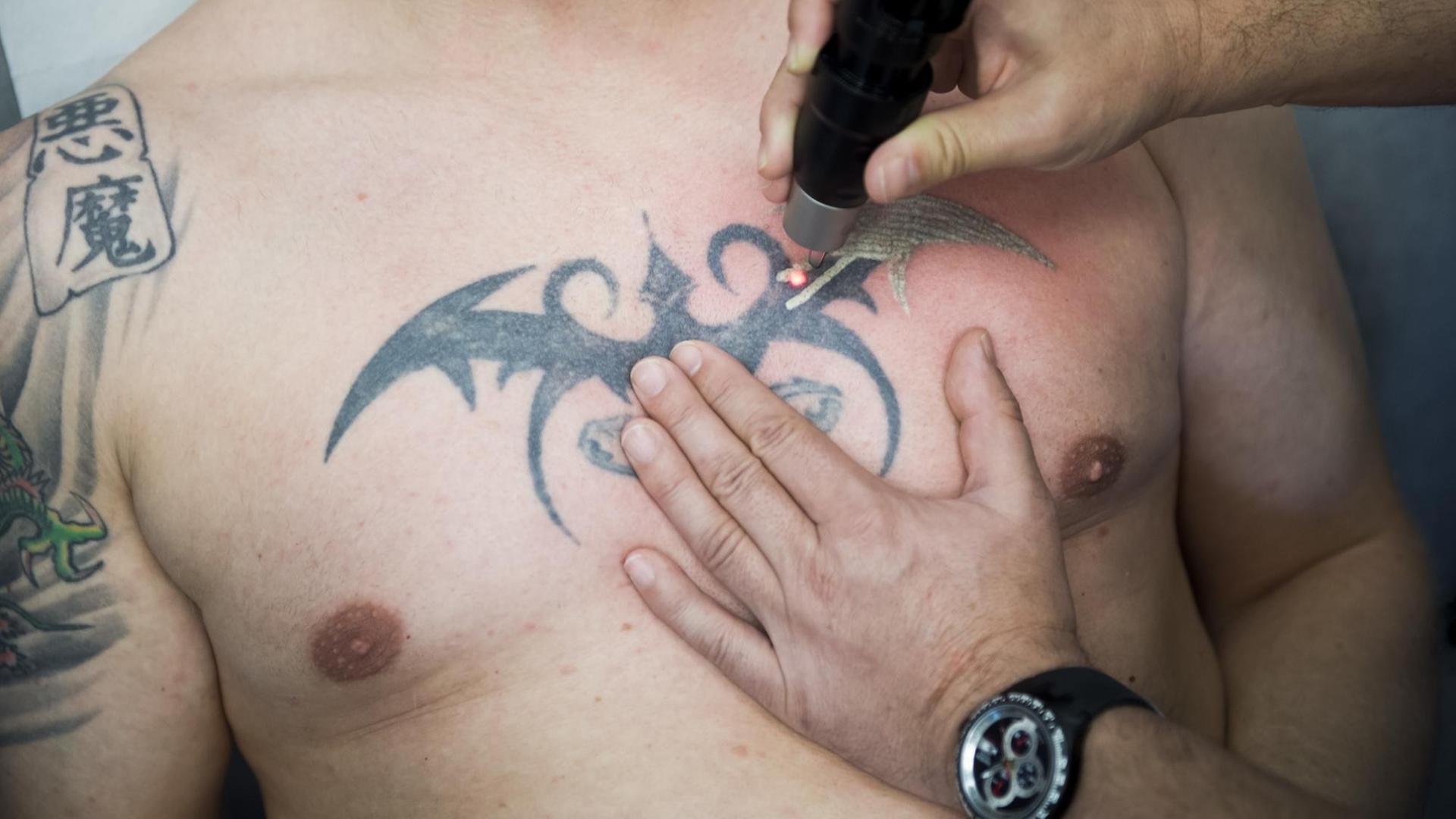 Einem Patienten der Universitäts Klinik Bochum (Nordrhein-Westfalen) wird mittels eines neuartigen Lasers ein Tattoo auf der Brust entfernt. Einem Patienten der Universitäts Klinik Bochum (Nordrhein-Westfalen) wird mittels eines neuartigen Lasers ein Tattoo auf der Brust entfernt.