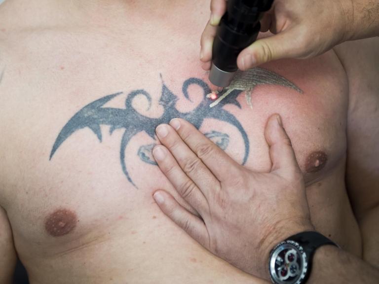 Einem Patienten der Universitäts Klinik Bochum (Nordrhein-Westfalen) wird mittels eines neuartigen Lasers ein Tattoo auf der Brust entfernt.