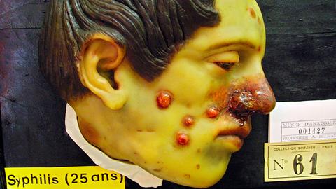 Ein Wachs-Gesicht verdeutlicht die Folgen der Krankheit Syphilis, hier ausgestellt im Pariser Museum Orfila-Rouvière (2001).