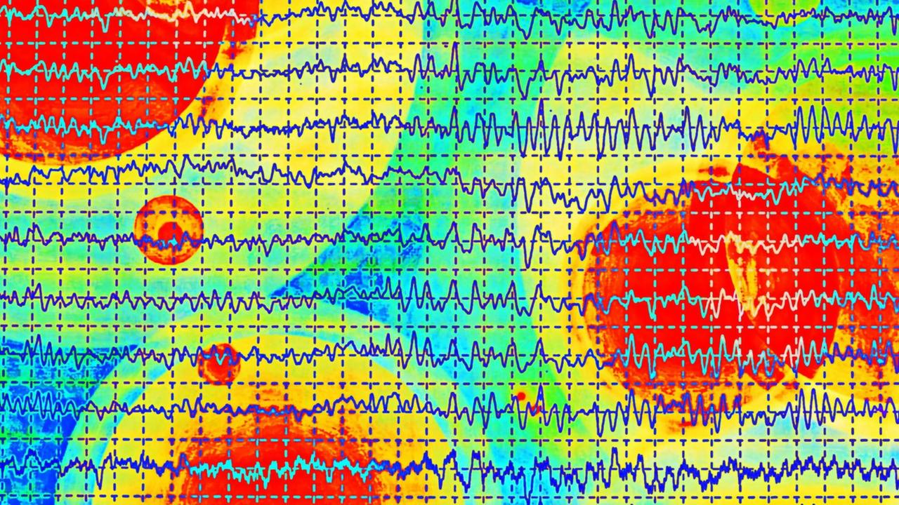 Darstellung von mehreren übereinanderliegenden Gehirnwellen im Elektroenzephalogramm (EEG), vor einem bunten Hintergrund. Darstellung von mehreren übereinanderliegenden Gehirnwellen im Elektroenzephalogramm (EEG), vor einem bunten Hintergrund.
