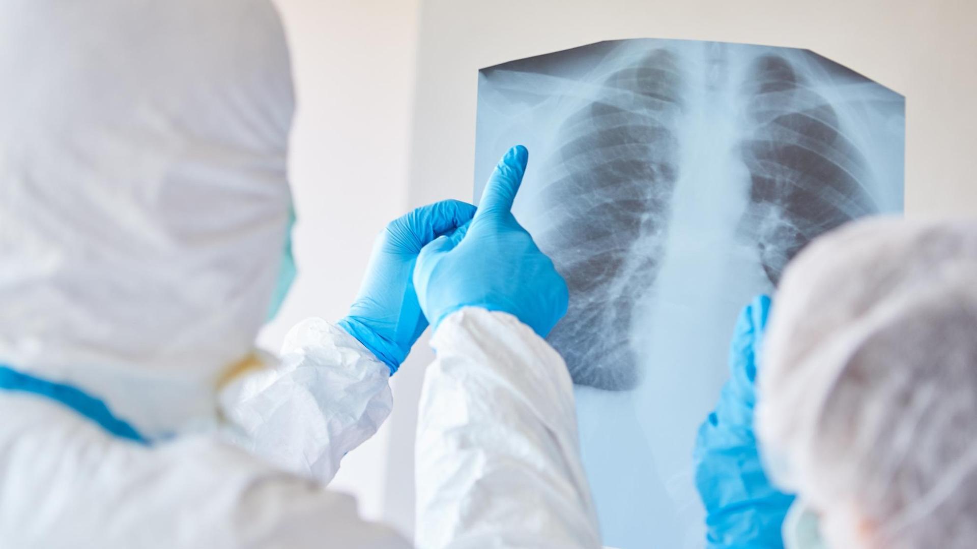 Ärzte in Schutzkleidung schauen sich ein Röntgenbild einer Lungenentzündung eines COVID-19 Patient an Ärzte in Schutzkleidung schauen sich ein Röntgenbild einer Lungenentzündung eines COVID-19 Patient an
