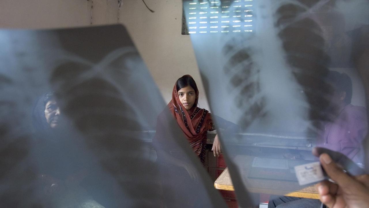 Dieses Mädchen in einer Arztpraxis im indischen Howrah ist nach sechsmonatiger Therapie von der Tuberkulose geheilt. Viele Patienten in Indien brechen die Medikamenten-Einnahme vorzeitig ab, teils auf Anraten von Quacksalbern, teils aus Geldmangel. Ein Nebeneffekt: Nicht abgetötete Erreger entwickeln Antibiotika-Resistenzen.