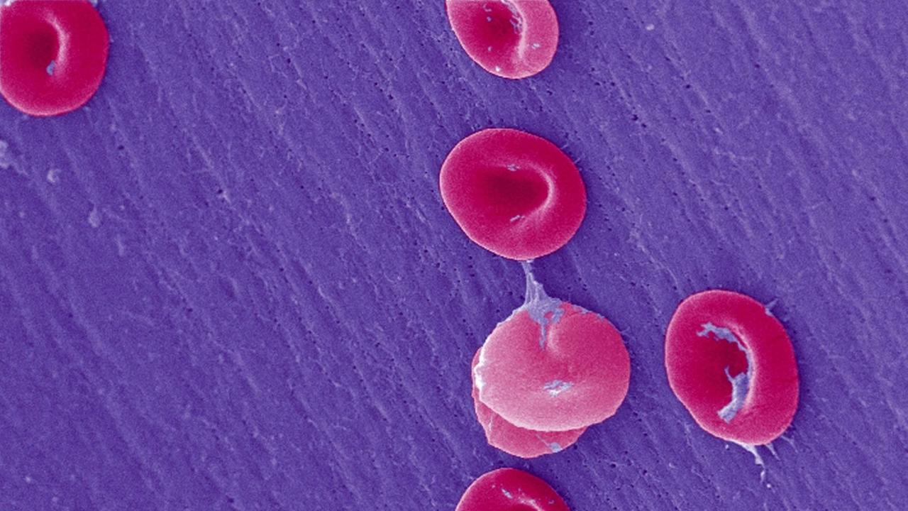 Mikroskopische Aufnahme: Charakteristisch verformte rote Blutkörperchen bei einer Sichelzell-Anämie Mikroskopische Aufnahme: Charakteristisch verformte rote Blutkörperchen bei einer Sichelzell-Anämie