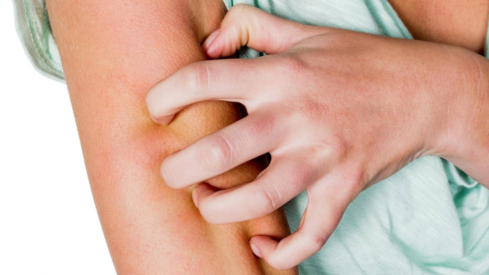 Das Bild zeigt eine Frau, die sich die juckende Haut am Arm kratzt Das Bild zeigt eine Frau, die sich die juckende Haut am Arm kratzt