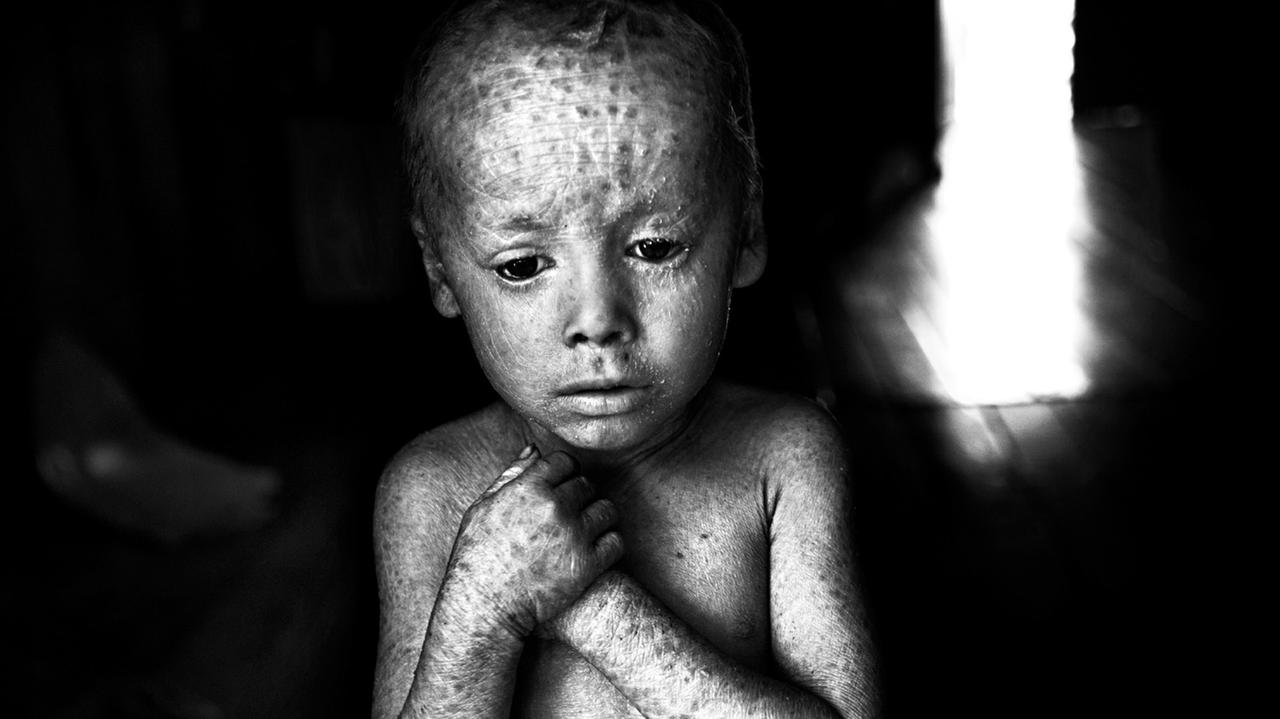 Kind in Argentinien mit mutmaßlicher Glyphosatschädigung Kind in Argentinien mit mutmaßlicher Glyphosatschädigung