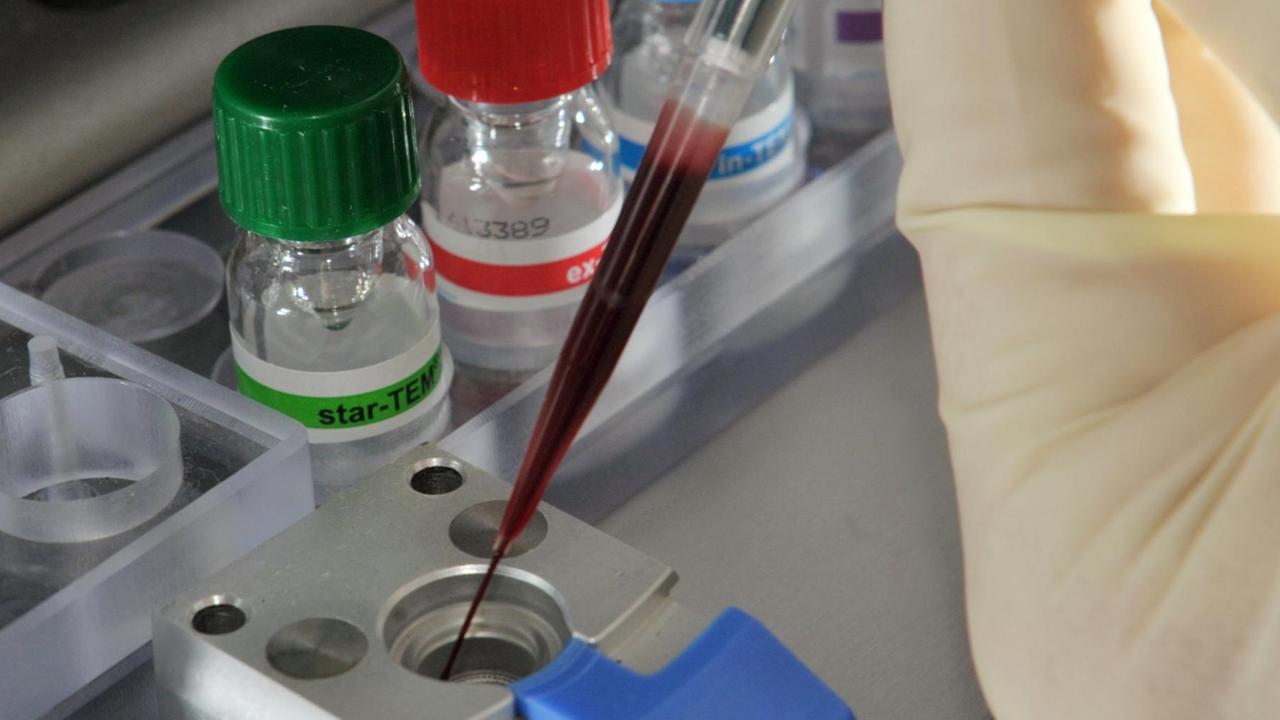 Hände in Gummihandschuhe hantieren mit einer Pipette mit Blut Hände in Gummihandschuhe hantieren mit einer Pipette mit Blut