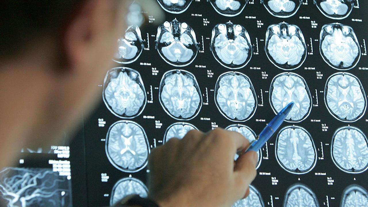 Der Arzt der Kinderonkologie deutet mit einem Kugelschreiber auf Bilder eines Magnet-Resonanz-Tomographen (MRT), die verschiedene Gehirnquerschnitte einer jungen Schlaganfall-Patientin.
Der Arzt der Kinderonkologie deutet mit einem Kugelschreiber auf Bilder eines Magnet-Resonanz-Tomographen (MRT), die verschiedene Gehirnquerschnitte einer jungen Schlaganfall-Patientin.