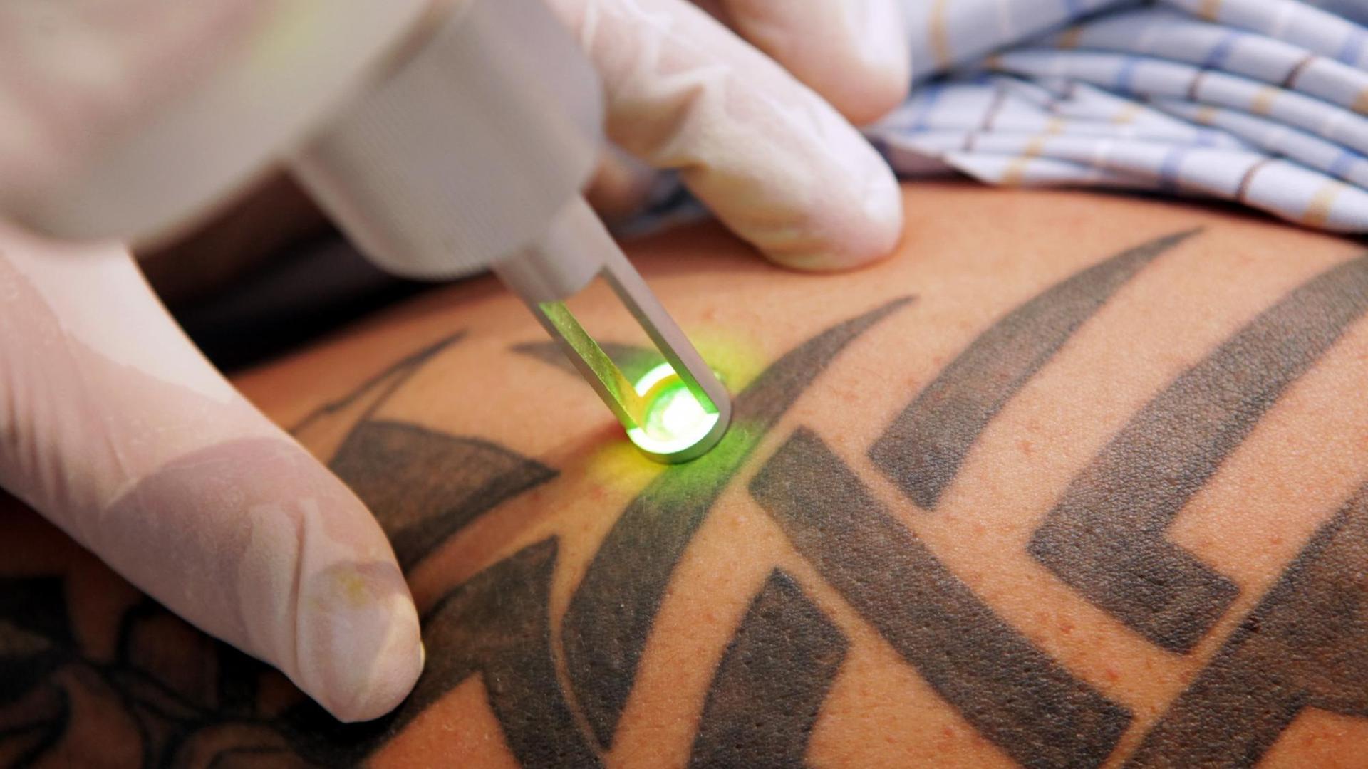 Ein Mann lässt sich seine riesige Tribal-Tätowierung mit Hilfe eines starken Lasers entfernen. Ein Mann lässt sich seine riesige Tribal-Tätowierung mit Hilfe eines starken Lasers entfernen.