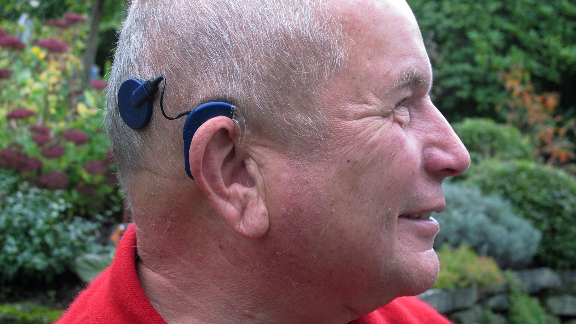 Patient mit Hörimplantat: Der Mann hat sich ein sogenanntes Cochlea-Implantat einsetzen lassen. Dabei wird hinter der Ohrmuschel ein Elektrodenträger in das Innenohr eingesetzt. Über ein kleines Mikrofon am Ohr werden die Töne und Laute über ein Kabel von außen zum Elektrodenträger geleitet - und der Hörnerv elektrisch stimuliert. Das Gehirn erkennt dann den Schall. Patient mit Hörimplantat: Der Mann hat sich ein sogenanntes Cochlea-Implantat einsetzen lassen. Dabei wird hinter der Ohrmuschel ein Elektrodenträger in das Innenohr eingesetzt. Über ein kleines Mikrofon am Ohr werden die Töne und Laute über ein Kabel von außen zum Elektrodenträger geleitet - und der Hörnerv elektrisch stimuliert. Das Gehirn erkennt dann den Schall.