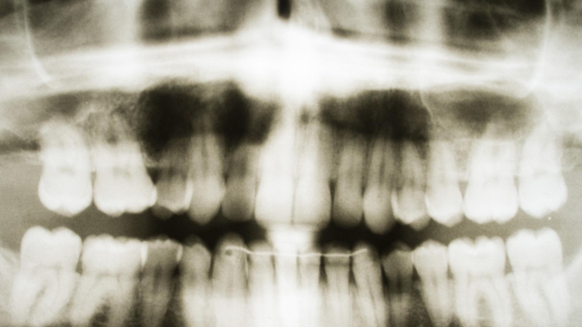 Ein Röntgenbild von einem Gebiss eines 28-jährigen Mannes hängt am 31.03.2014 in einer Zahnarztpraxis in Hannover (Niedersachsen).