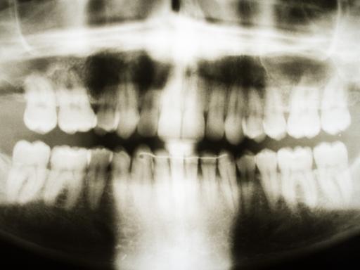 Ein Röntgenbild von einem Gebiss eines 28-jährigen Mannes hängt am 31.03.2014 in einer Zahnarztpraxis in Hannover (Niedersachsen).