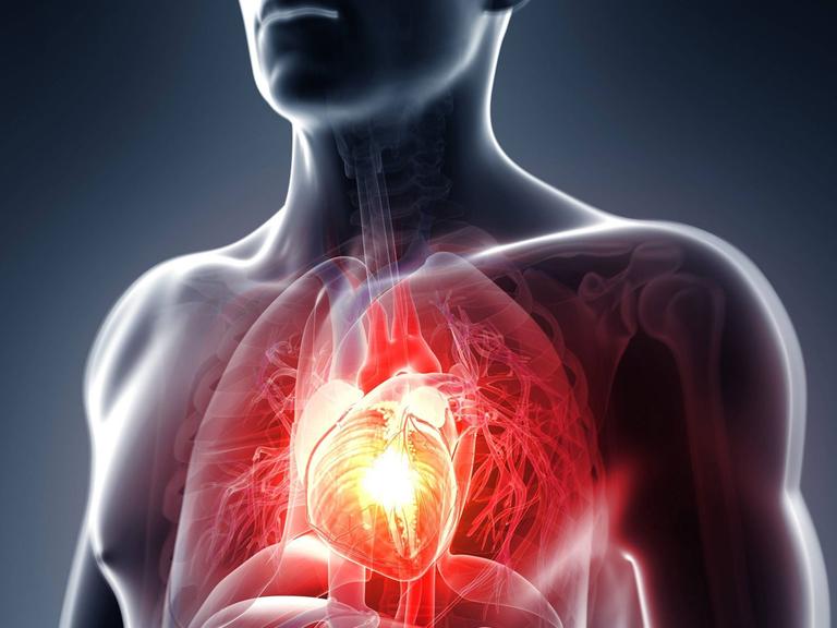Computergrafik eines Herzinfarkts