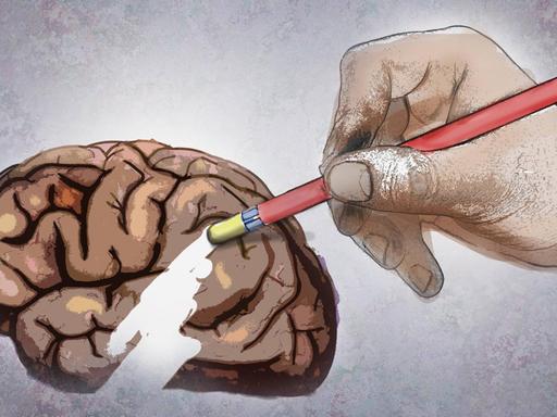 Illustration: eine große Hand löscht einen Teil des Gehirns mit einem Radiergummi am Ende eines Bleistifts.