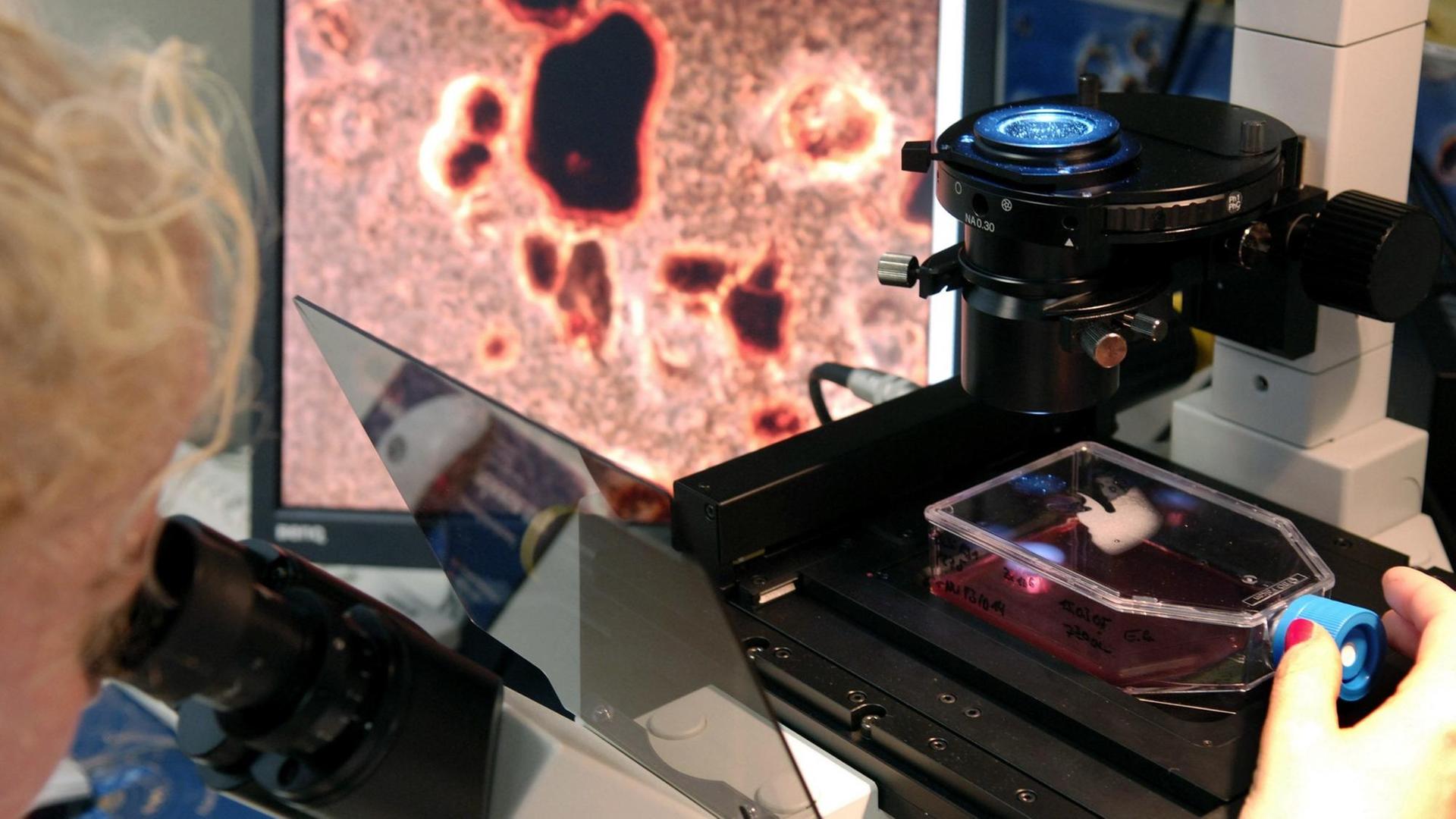 Durch ein Mikroskop ist der Anreicherungsprozess von Nanopartikeln in Krebszellen zu sehen. Durch ein Mikroskop ist der Anreicherungsprozess von Nanopartikeln in Krebszellen zu sehen.