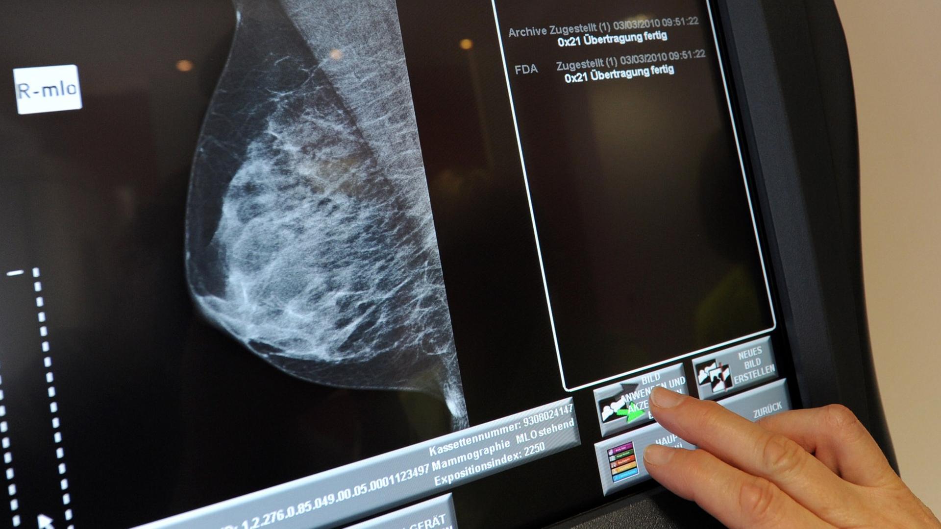 Eine Medizinisch-technische Radiologieassistenten (MTRA) überprüft am Donnerstag (04.03.2010) in Hannover in dem Mammografie Screening Zentrum eine Aufnahme einer Brust. Eine Medizinisch-technische Radiologieassistenten (MTRA) überprüft am Donnerstag (04.03.2010) in Hannover in dem Mammografie Screening Zentrum eine Aufnahme einer Brust.