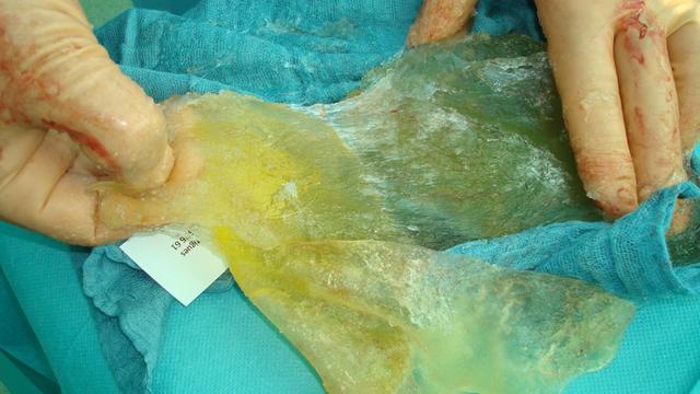 Ein gerissenes Brustimplantant wurde von Chirurgen in einer OP entfernt und liegt nun auf einem Tuch.