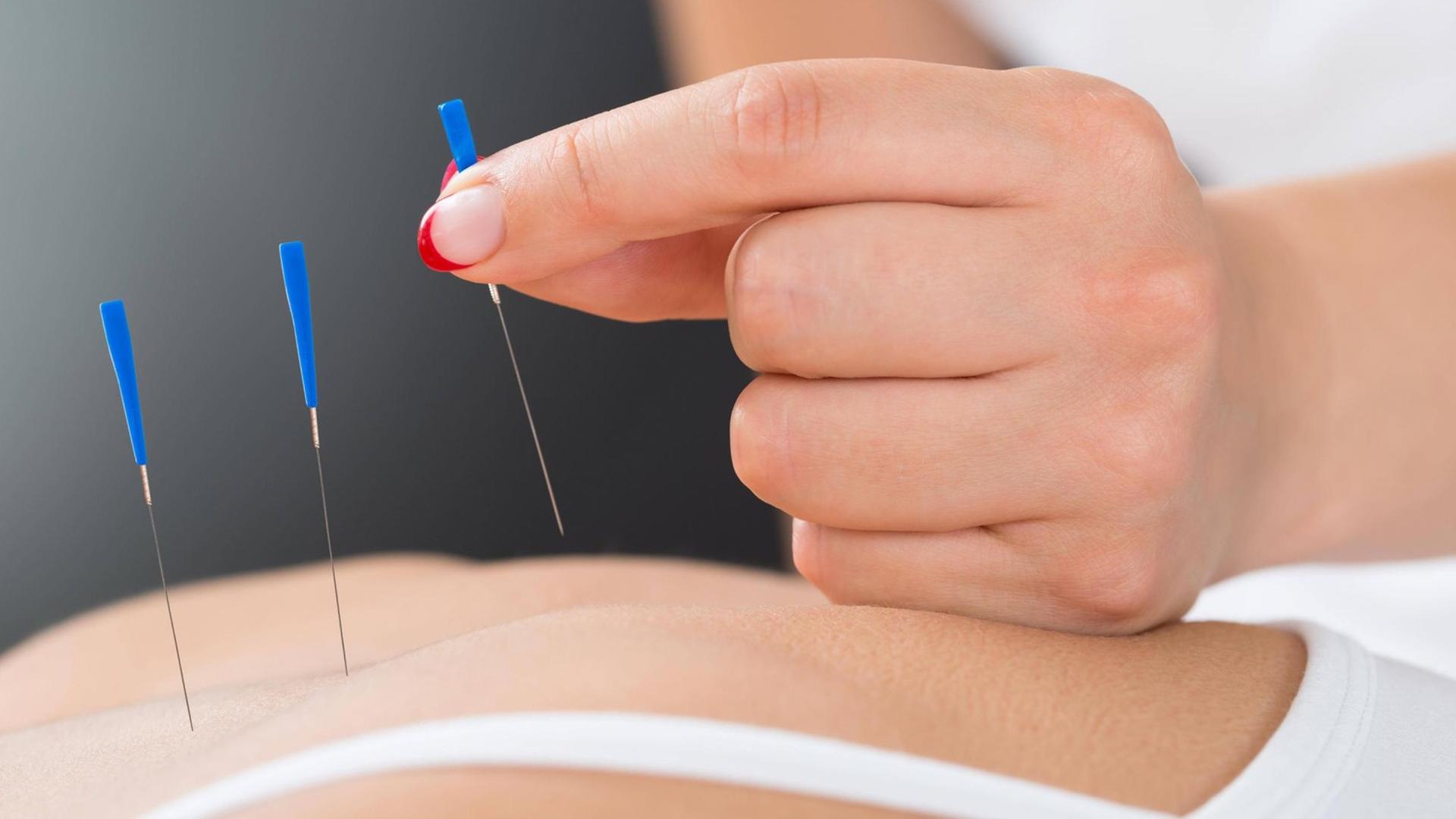 Akupunkturbehandlung: Eine Frau sticht einer Patientin mehrere Nadeln in den Rücken. Akupunkturbehandlung: Eine Frau sticht einer Patientin mehrere Nadeln in den Rücken.