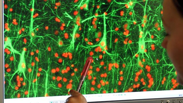 Die DNA-Färbung von Alzheimer-Hirngewebe, dargestellt auf einem Bildschirm. 