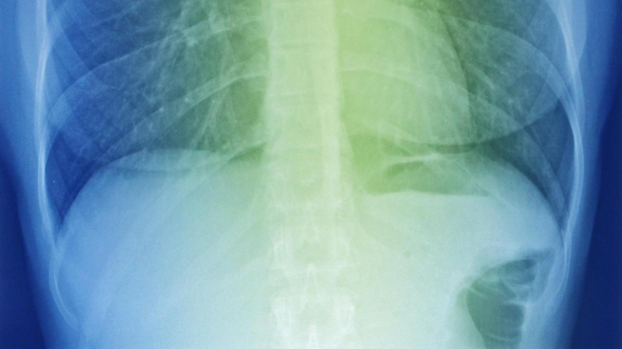 Thorax Röntgenbild, Untersuchung des Brustkorbes und Lunge, Zwerchfell, Rippen, - 20140411_PD6681 |
