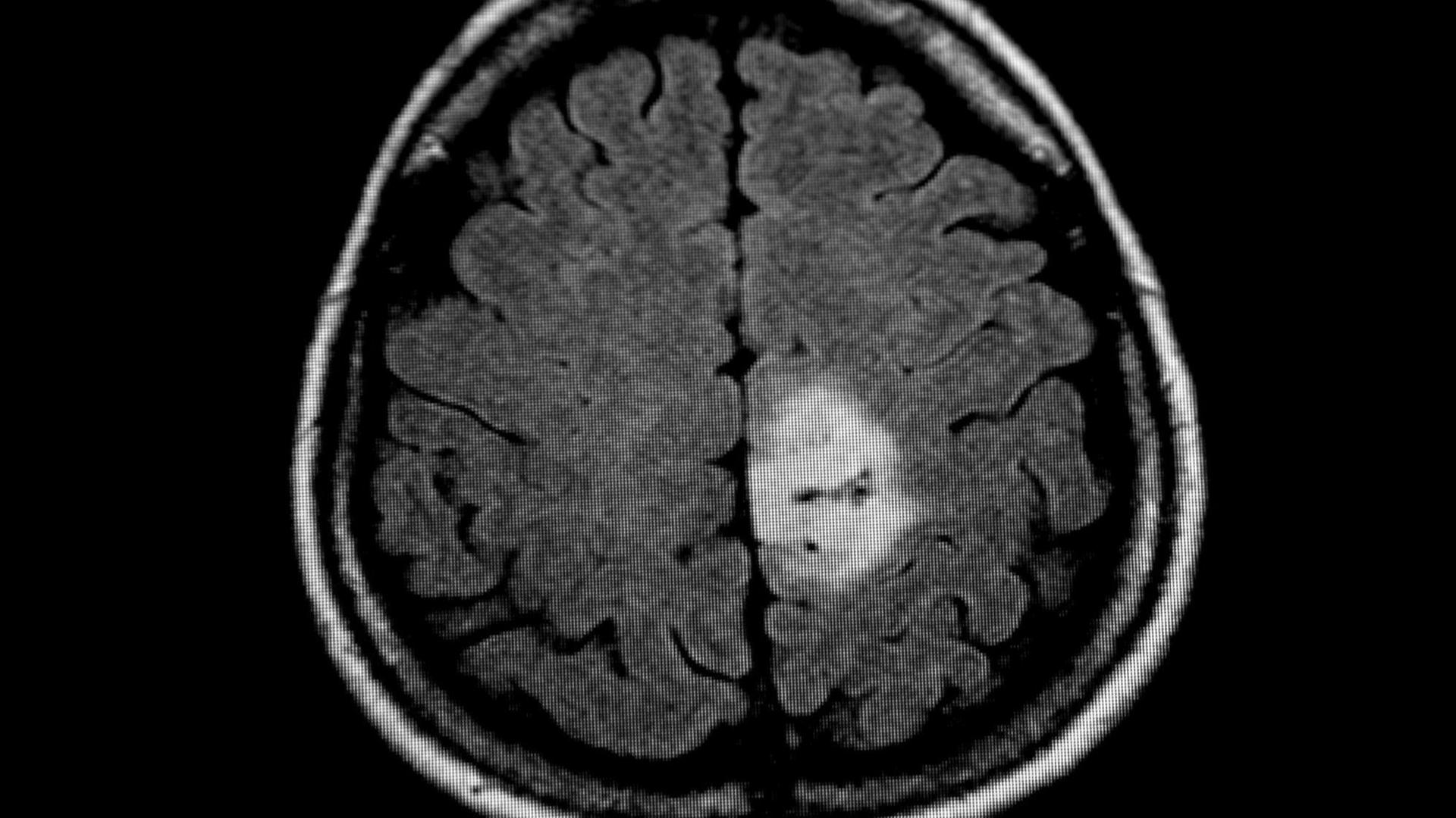 Das MRT-Bild des Gehirntumors (heller Fleck) Das MRT-Bild des Gehirntumors (heller Fleck)