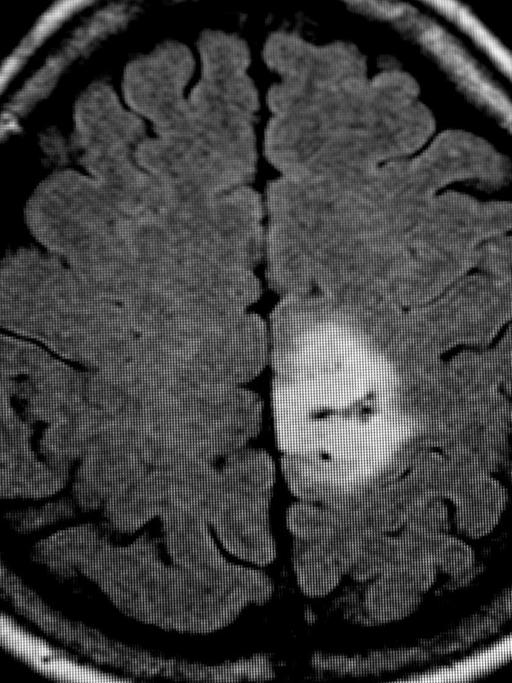 Das MRT-Bild des Gehirntumors (heller Fleck)