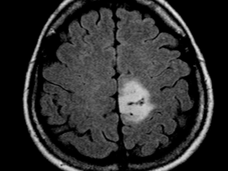 Das MRT-Bild des Gehirntumors (heller Fleck)