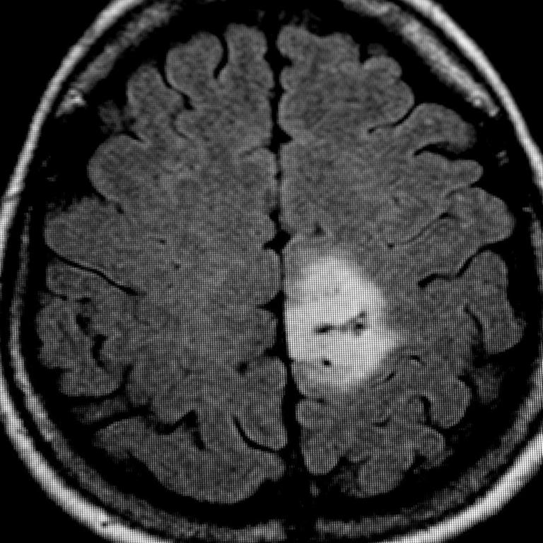 Das MRT-Bild des Gehirntumors (heller Fleck) 