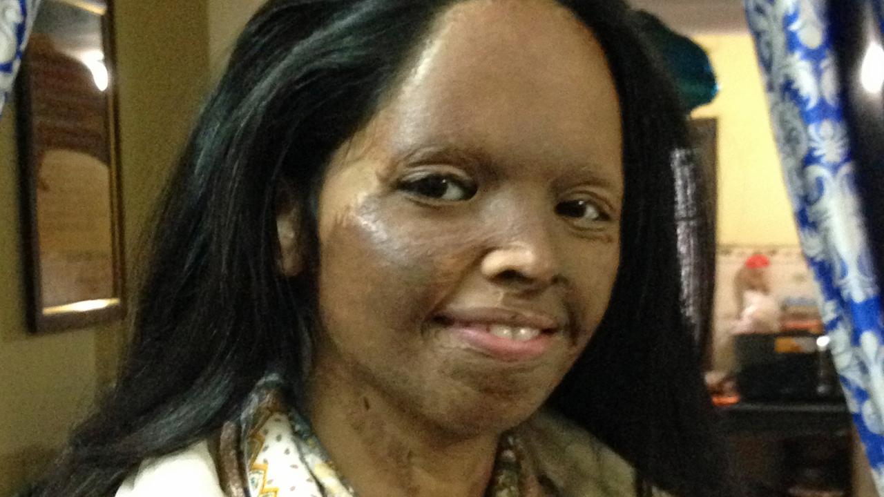 Die Inderin Laxmi Saa wurde im Alter von 15 Jahren Opfer eines Säureattentats. Die Inderin Laxmi Saa wurde im Alter von 15 Jahren Opfer eines Säureattentats.