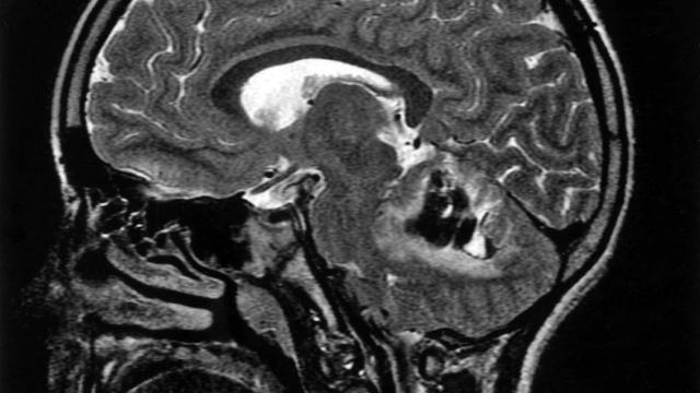 MRT eines Kopfes mit einer Hirnblutung