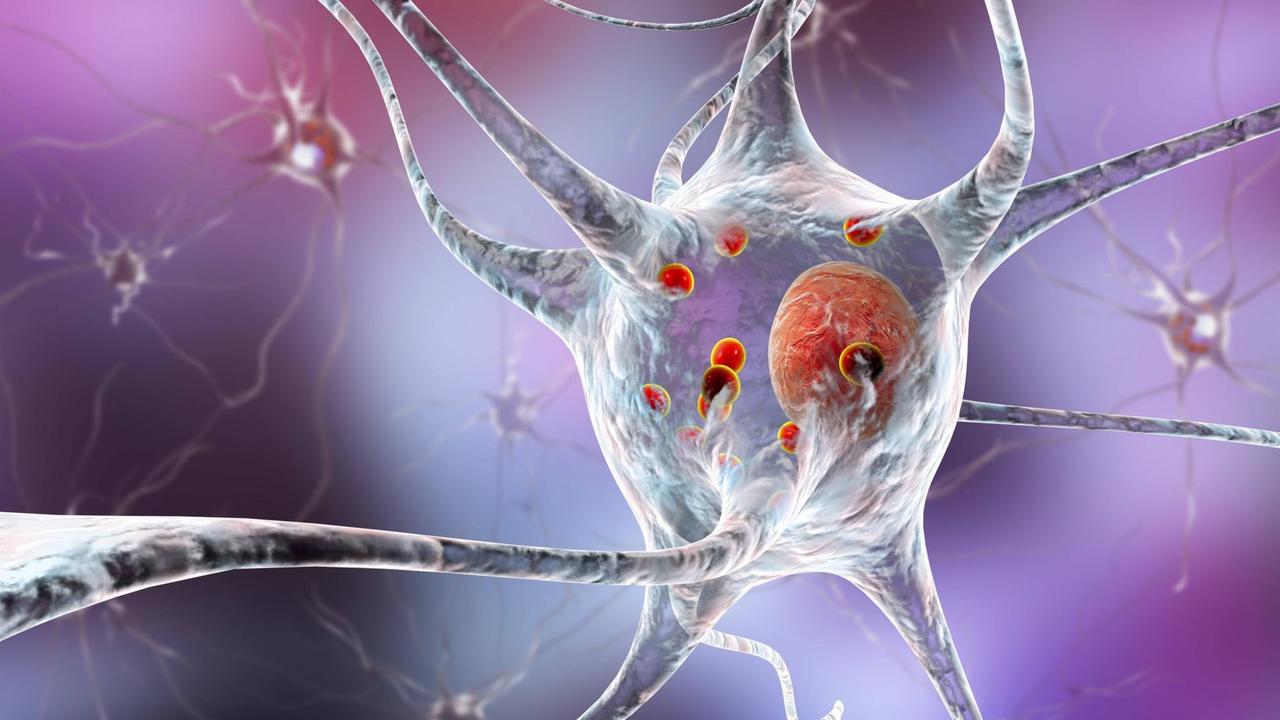 Illustration einer Parkinson-geschädigten Nervenzelle. Die roten Punkte sind die sogenannten Lewy-Körper - die Proteinablagerungen führen zum Absterben der dopaminbildenden Neuronen Illustration einer Parkinson-geschädigten Nervenzelle. Die roten Punkte sind die sogenannten Lewy-Körper - die Proteinablagerungen führen zum Absterben der dopaminbildenden Neuronen