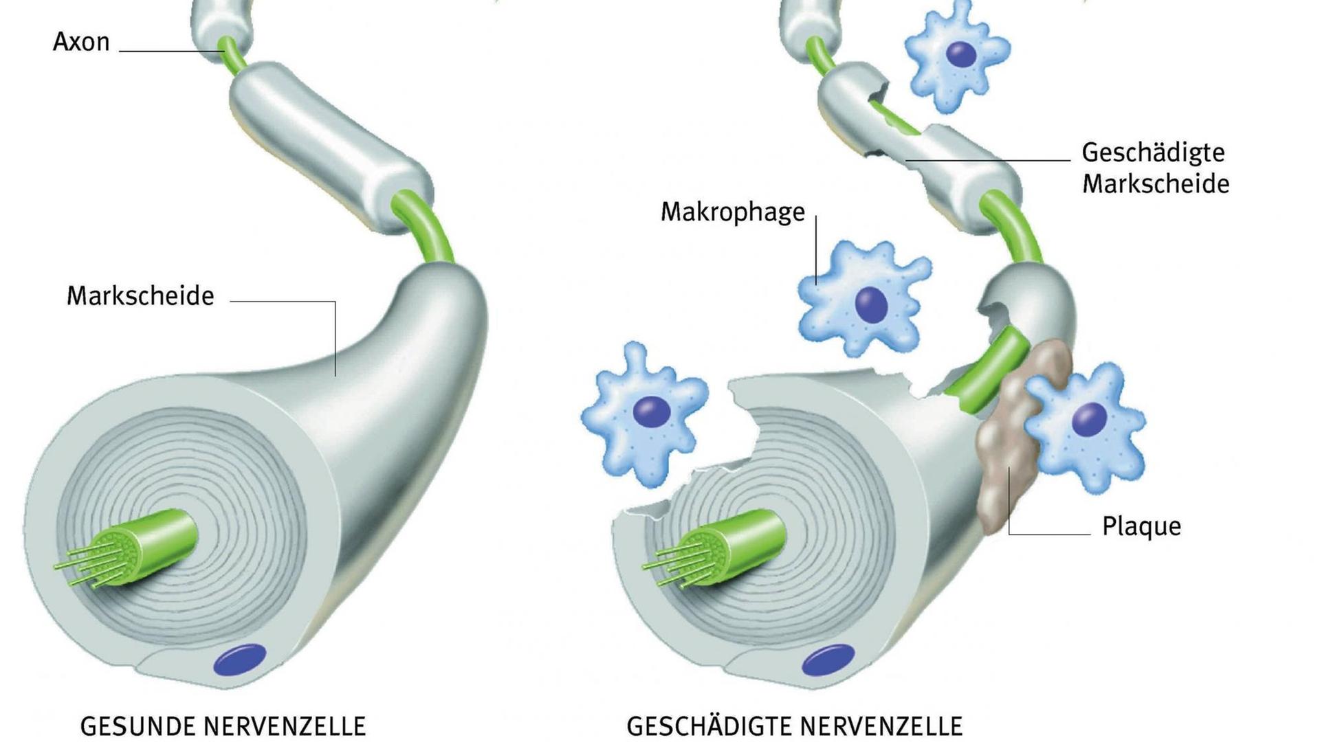 Die Illustration zeigt eine gesunde (l) und eine von Makrophagen geschädigte Nervenzelle (r).