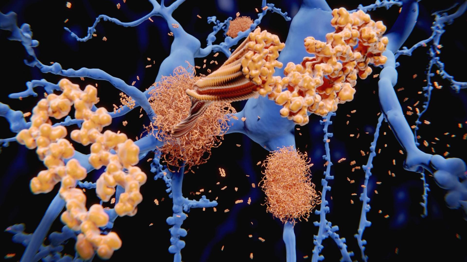 Illustration der Entstehung von Amyloid-Plaques (gelb) auf den Nervenzellen des Gehirns (blau)