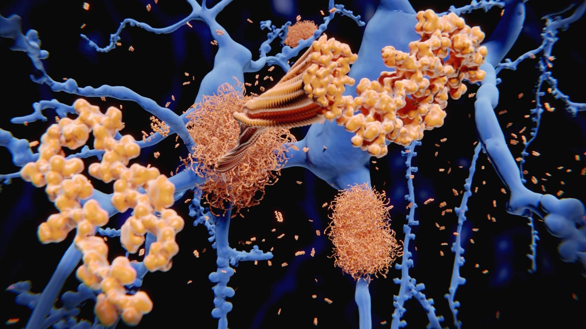 Illustration der Entstehung von Amyloid-Plaques (gelb) auf den Nervenzellen des Gehirns (blau) Illustration der Entstehung von Amyloid-Plaques (gelb) auf den Nervenzellen des Gehirns (blau)