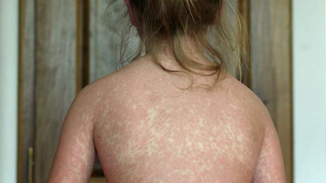 Der Rücken eines Mädchens, das an Masern erkrankt ist.