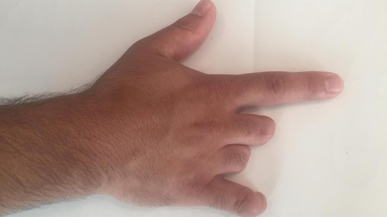 Die Hand des 28 Jahre alten Afghanen, dem die Taliban die Finger abgeschnitten haben, weil er westliche Musik auf seiner Gitarre gespielt hat Die Hand des 28 Jahre alten Afghanen, dem die Taliban die Finger abgeschnitten haben, weil er westliche Musik auf seiner Gitarre gespielt hat