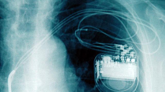 Auf dem Röntgenbild eines Brustkorbs ist ein implantierter Herzschrittmacher zu erkennen