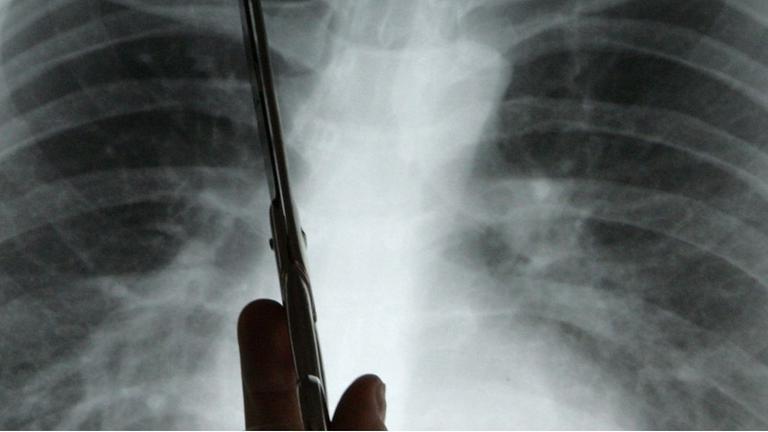 Diagnose Lungenkrebs: Ein Arzt zeigt auf einem Röntgenbild auf einen Tumor. Diagnose Lungenkrebs: Ein Arzt zeigt auf einem Röntgenbild auf einen Tumor.