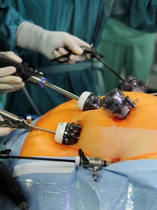 OP-Saal: Ärzteteam arbeitet an der Magenverkleinerung einer stark übergewichtigen Patientin