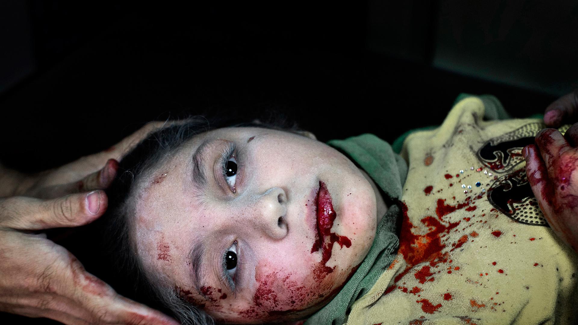 Ein syrisches Mädchen in einem Krankenhaus in Aleppo - das UNICEF-Foto des Jahres Ein syrisches Mädchen in einem Krankenhaus in Aleppo - das UNICEF-Foto des Jahres