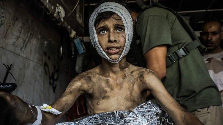 Der jesidische Junge Thomas Abdallah Hammou trägt einen Verband um den Kopf. Bei einem Luftangriff der Anti-"IS"-Koalition wurde Thomas schwer verletzt aus Trümmern geborgen, dann operiert. 