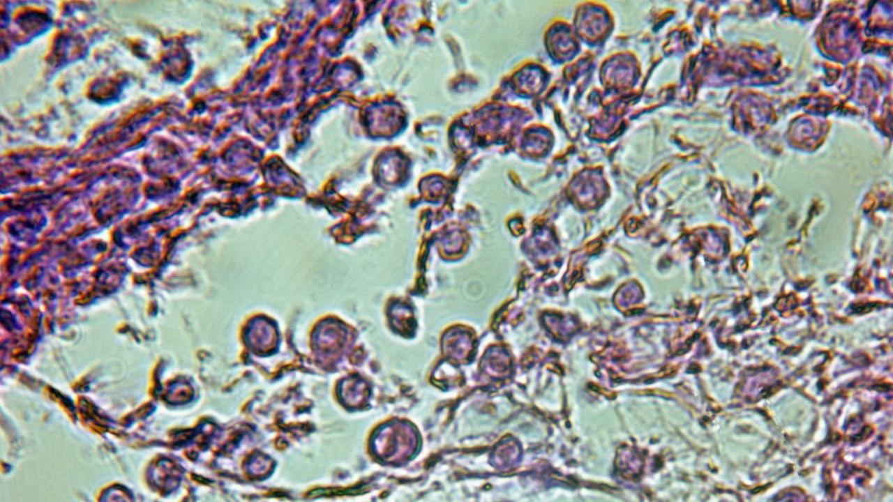 Mikroskopische Aufnahme von Tuberkel-Bakterien in einer tuberkulösen Lunge; Maßstab 700:1 Mikroskopische Aufnahme von Tuberkel-Bakterien in einer tuberkulösen Lunge; Maßstab 700:1