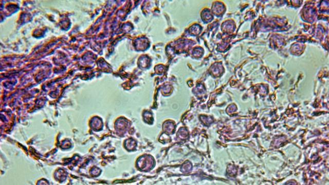 Mikroskopische Aufnahme von Tuberkel-Bakterien in einer tuberkulösen Lunge; Maßstab 700:1