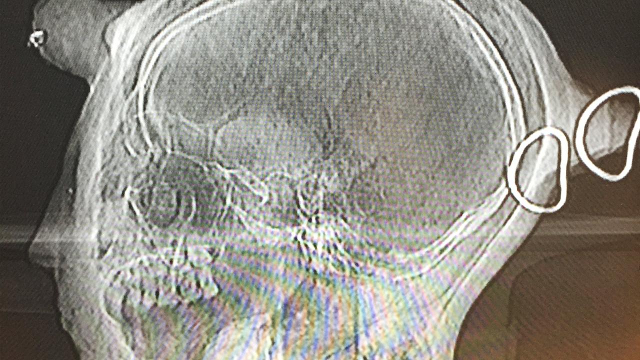 Die Diagnose der Ärzte: es fehlt der Unterkiefer. Doch dieser ist unbedingt nötig, um sicher das Geschlecht festlegen zu können. Fest steht: der Kopf wurde mit roher Gewalt vom Rest der Mumie entfernt. Die Stuckmaske kam erst später dazu. Die Diagnose der Ärzte: es fehlt der Unterkiefer. Doch dieser ist unbedingt nötig, um sicher das Geschlecht festlegen zu können. Fest steht: der Kopf wurde mit roher Gewalt vom Rest der Mumie entfernt. Die Stuckmaske kam erst später dazu.