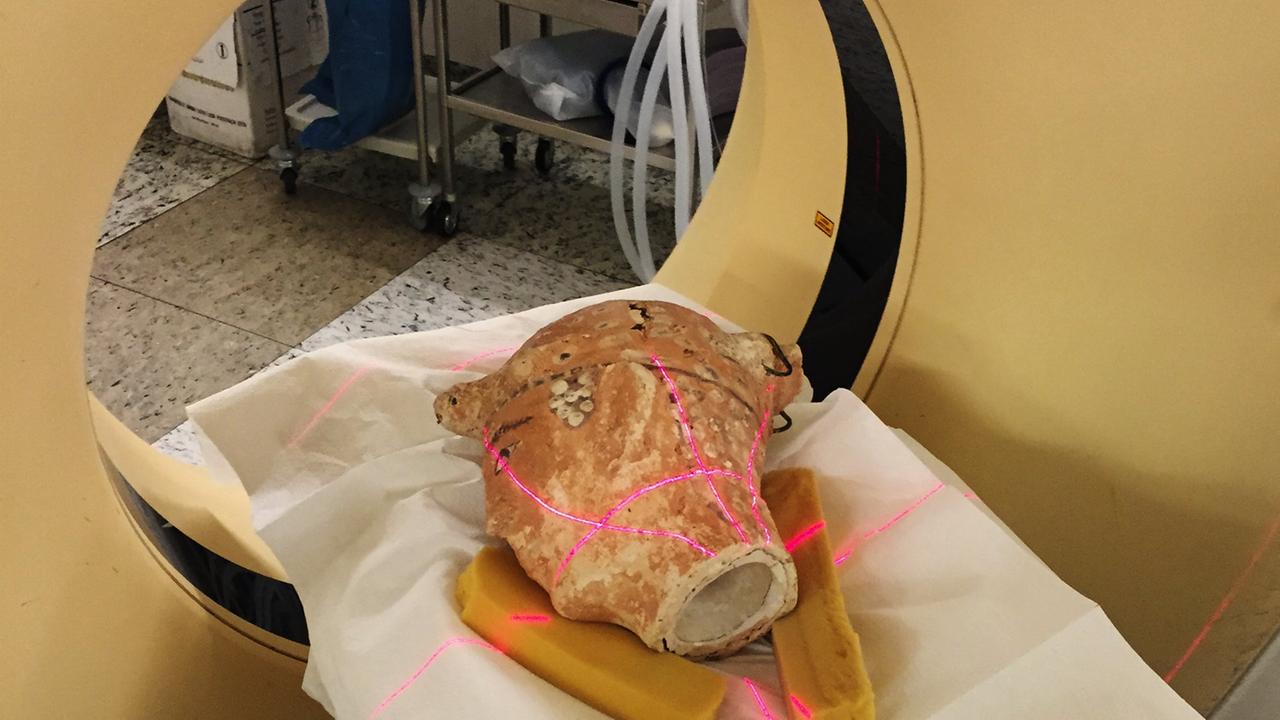 Chefarztbehandlung im Klinikum München-Bogenhausen. In der Radiologie wird der Stuckkopf mithilfe der Computertomographie untersucht. Chefarztbehandlung im Klinikum München-Bogenhausen. In der Radiologie wird der Stuckkopf mithilfe der Computertomographie untersucht.