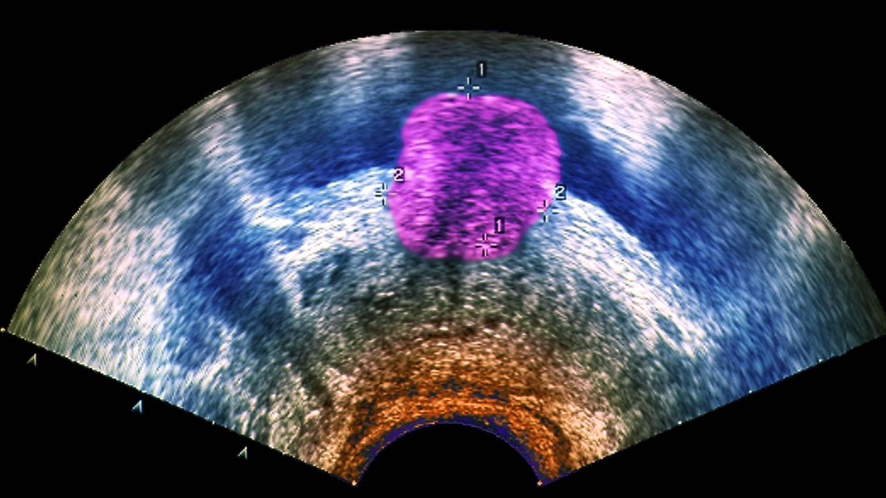 Ein Ultraschallbild eines Prostata-TumorsProstata Krebs Männer Ultraschall Urologe Urologie