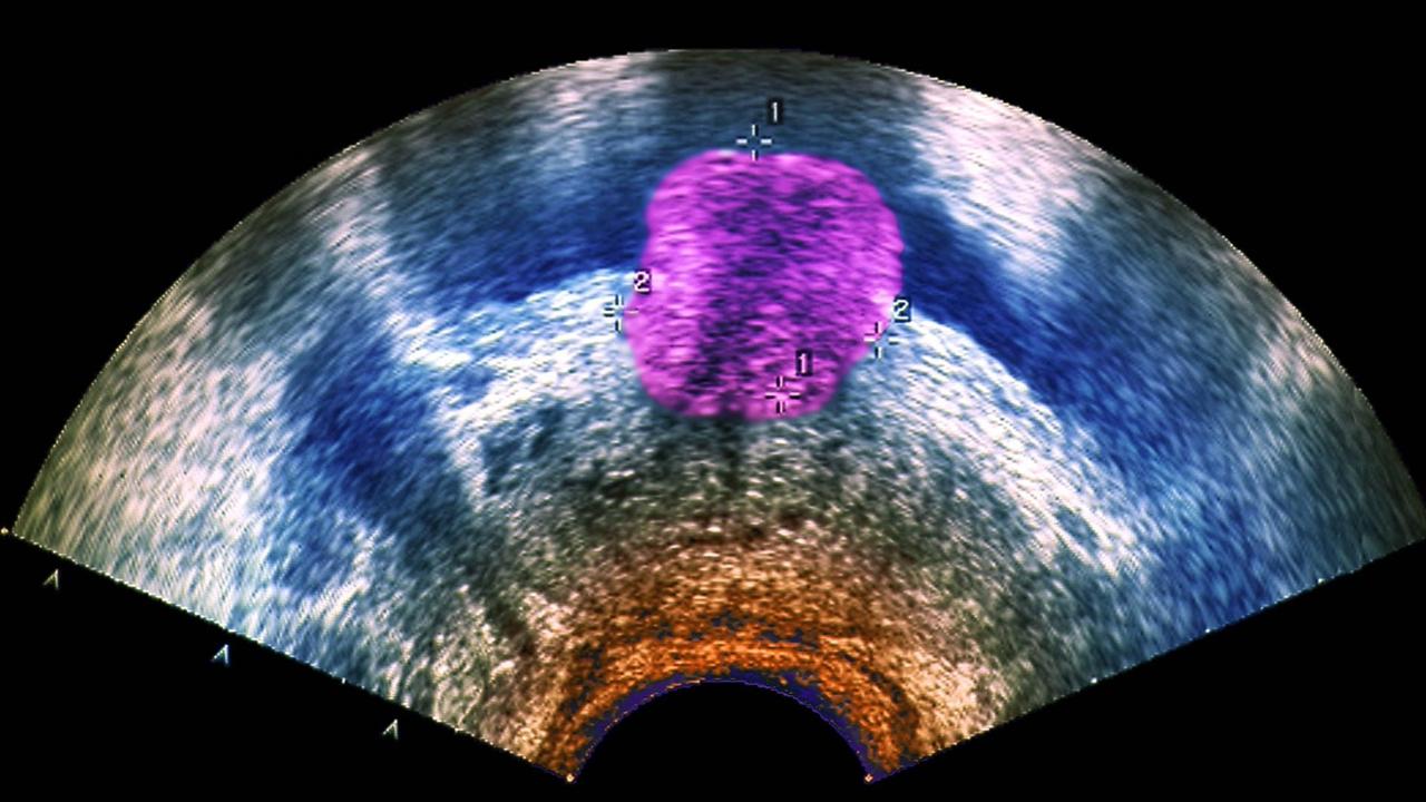 Ein Ultraschallbild eines Prostata-TumorsProstata Krebs Männer Ultraschall Urologe Urologie Ein Ultraschallbild eines Prostata-TumorsProstata Krebs Männer Ultraschall Urologe Urologie