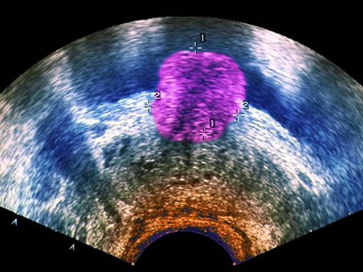Ein Ultraschallbild eines Prostata-Tumors Prostata Krebs Männer Ultraschall Urologe Urologie